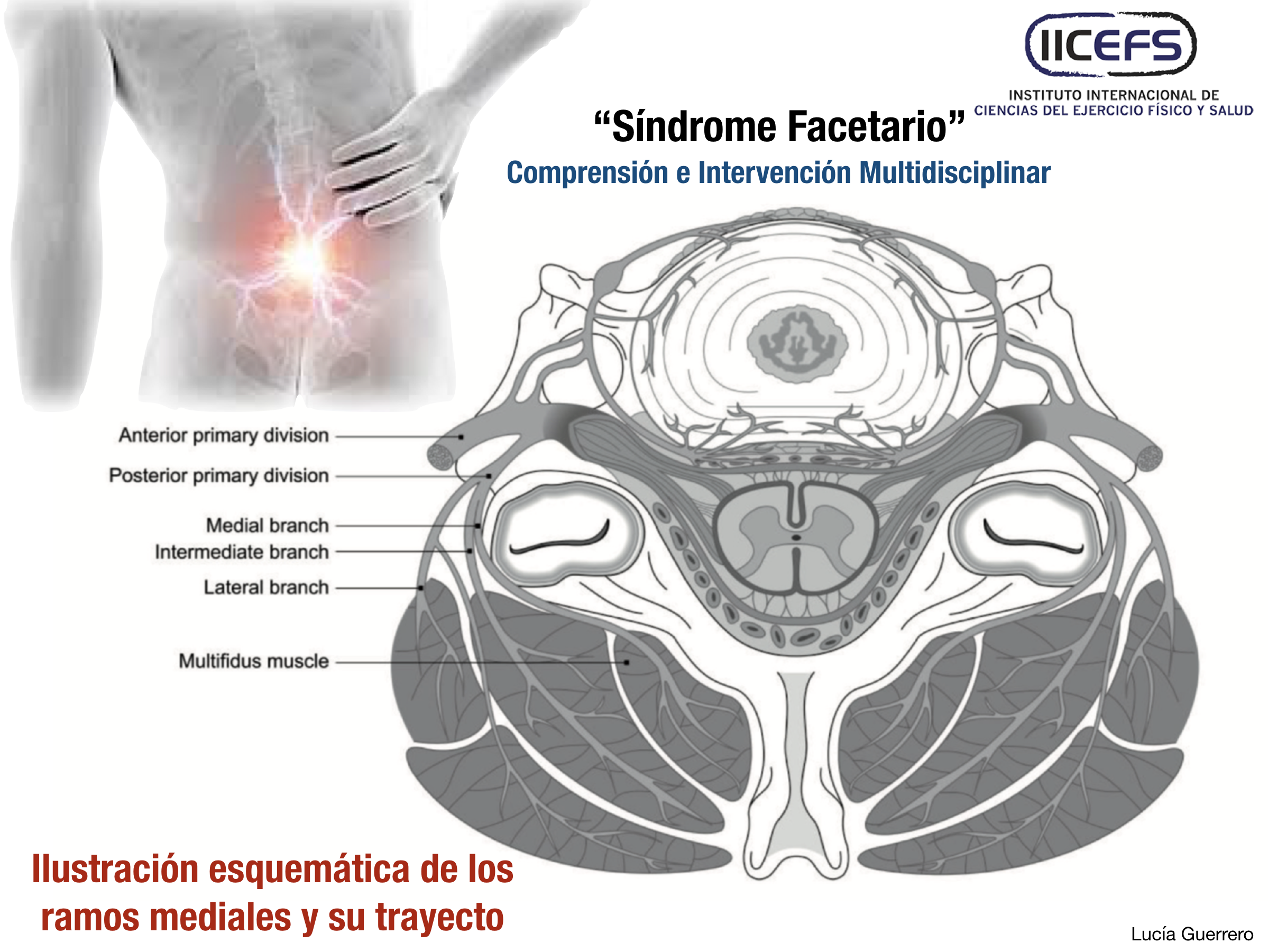 "Síndrome Facetario": Comprensión e Intervención Multidisciplinar