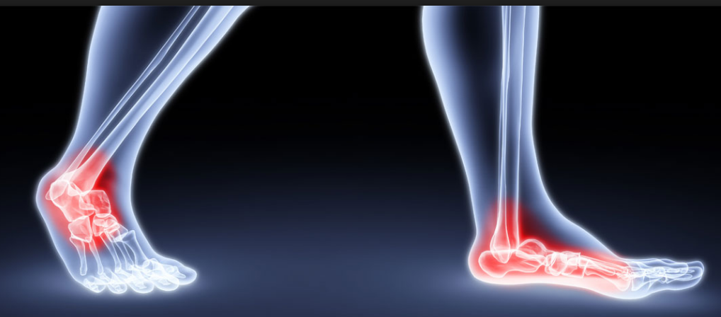 Sarcopenia, diabetes, neuropatía diabética y pie diabético